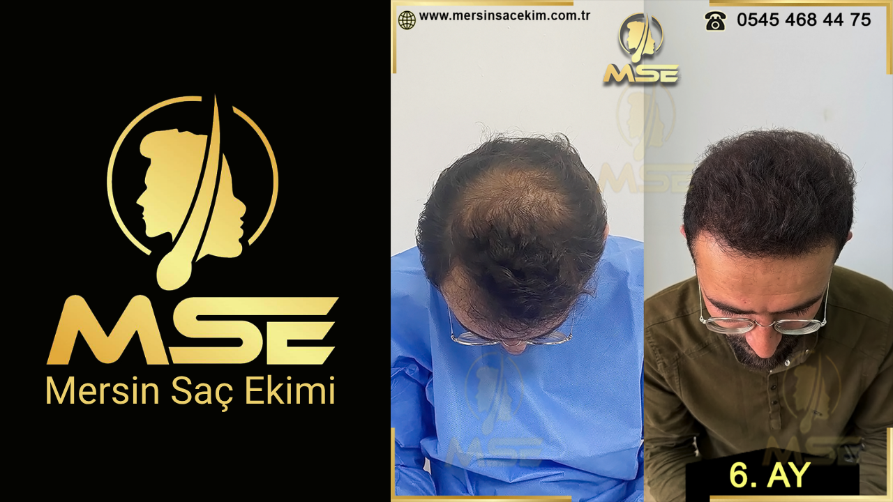 MERSİN SAÇ EKİMİ